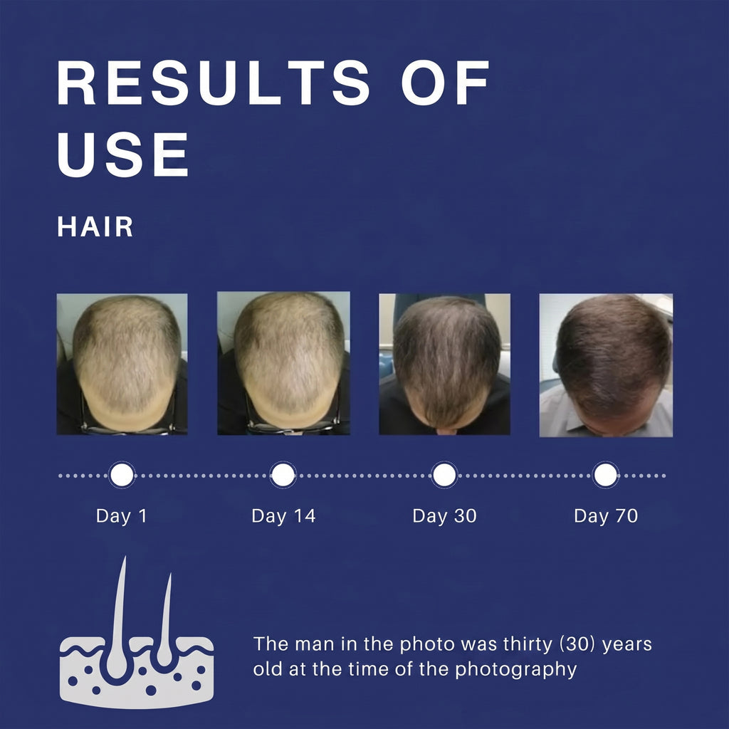 ROEGAN Minoxidil 5% for Men | BPOM Registered & Halal Hair and Beard Growth Solution