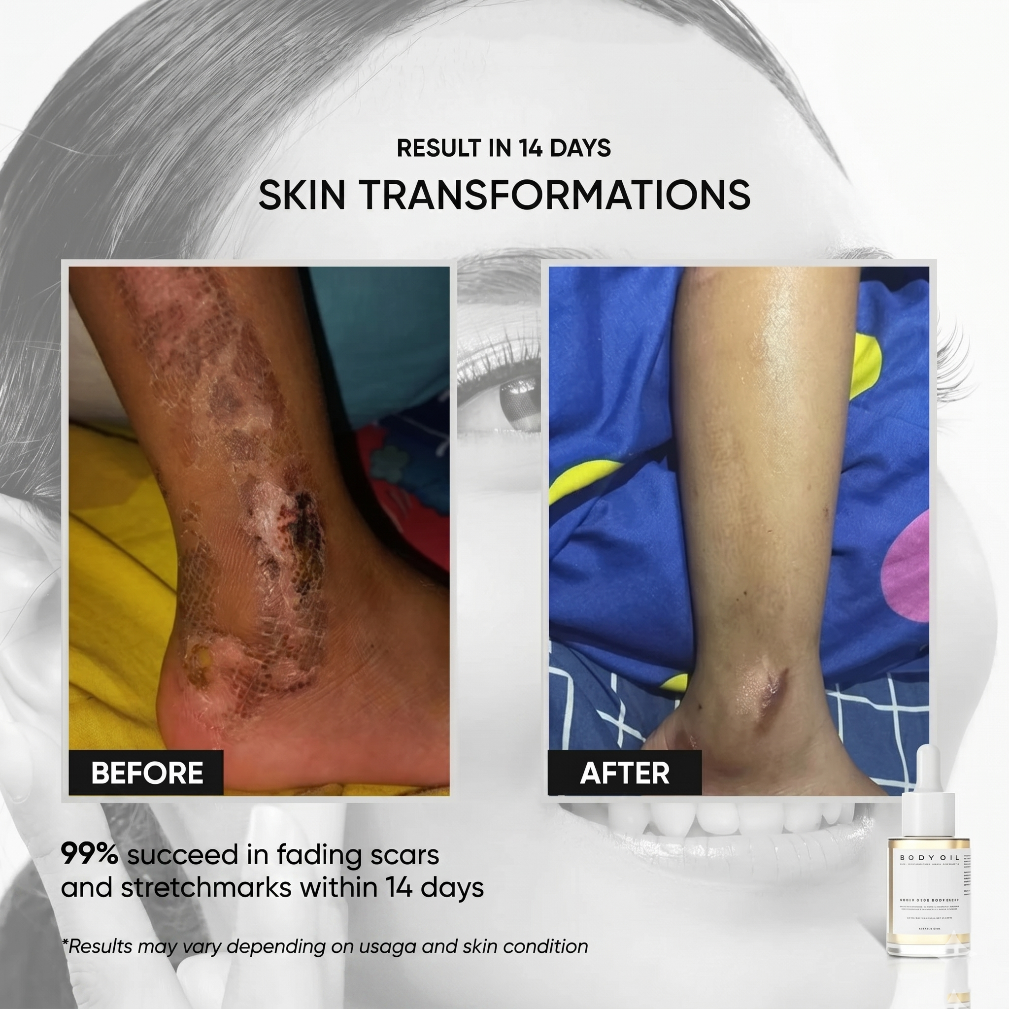 D’SAVIOR Body Oil 100ml | Helps Reduce Scars, Eczema, Psoriasis, Stretch Marks & Allergy Itching