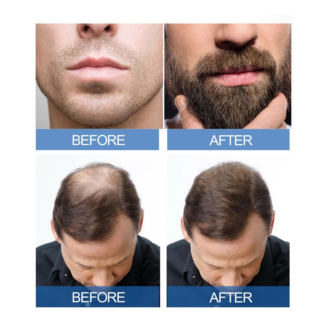 OSADA OSADI Minoxidil 5% Hair & Beard Growth Solution for Men (4-Pack)