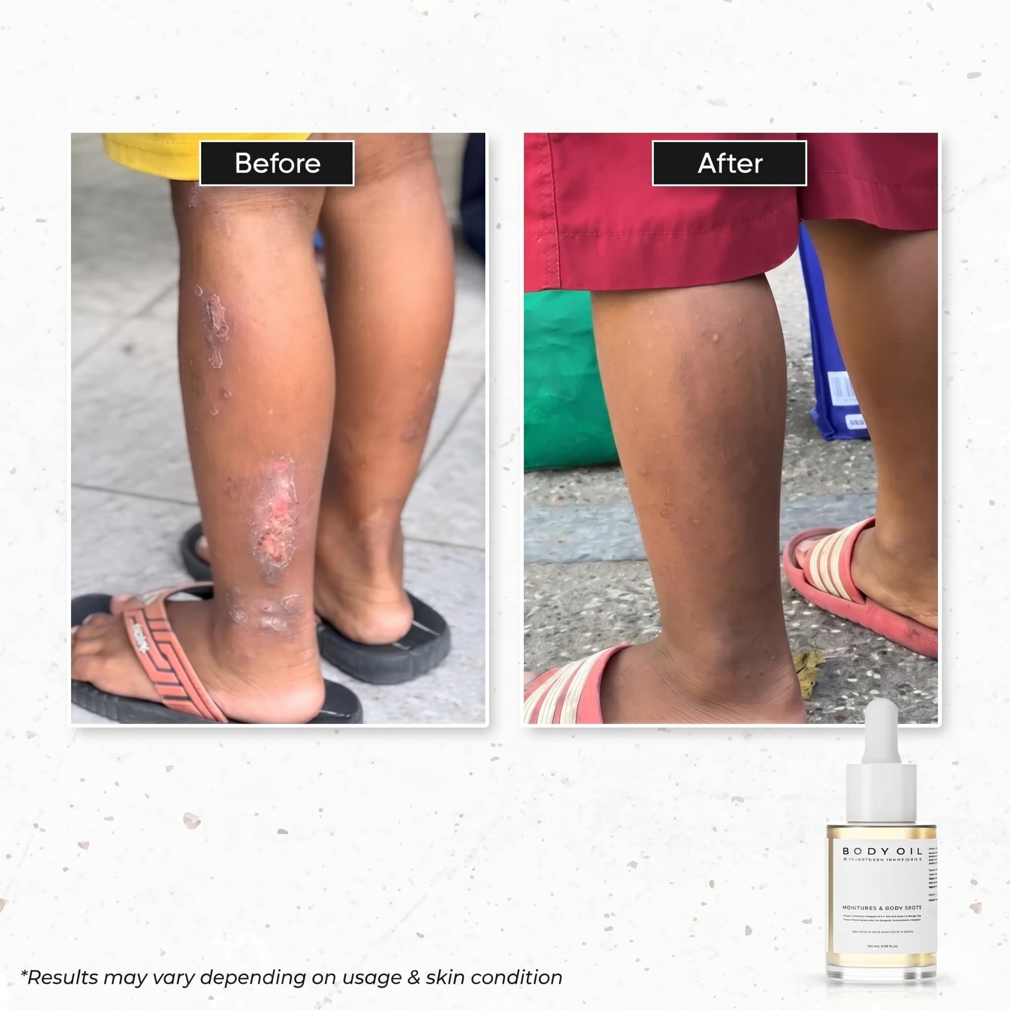 D’SAVIOR Body Oil 100ml | Helps Reduce Scars, Eczema, Psoriasis, Stretch Marks & Allergy Itching